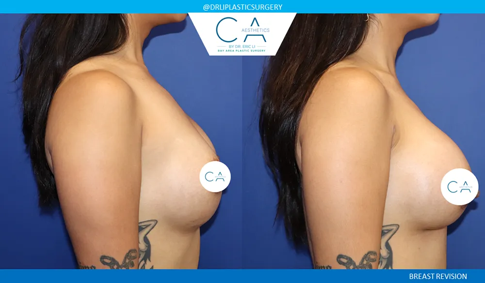 Breast Revision case #9527