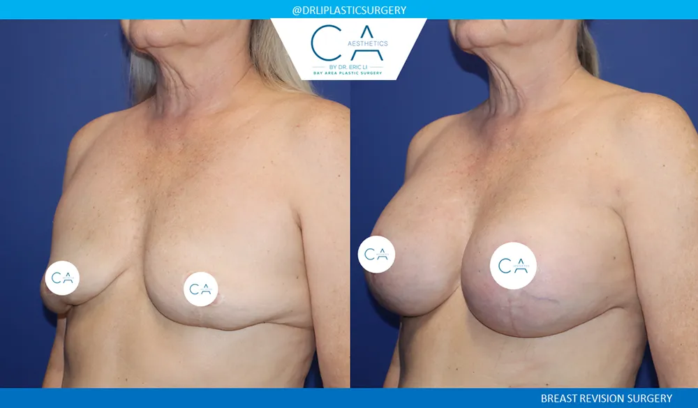 Breast Revision case #9521