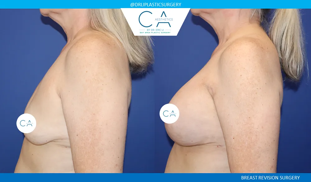 Breast Revision case #9521