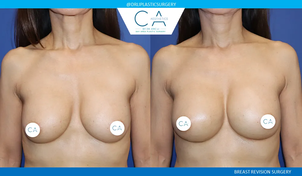 Breast Revision case #9515