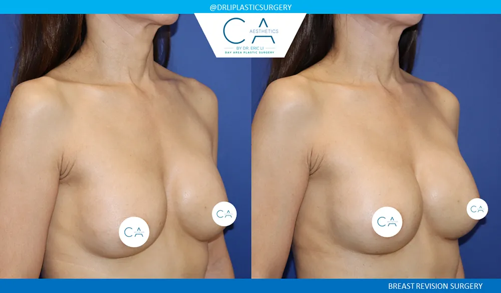 Breast Revision case #9515
