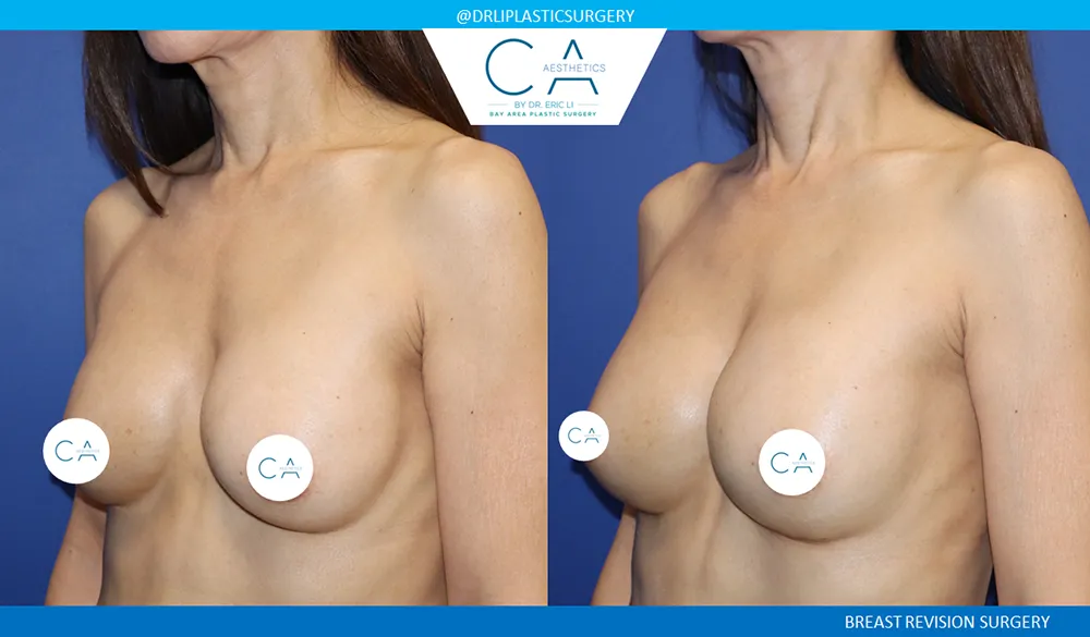 Breast Revision case #9515