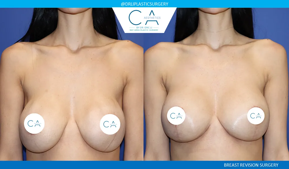 Breast Revision case #9509