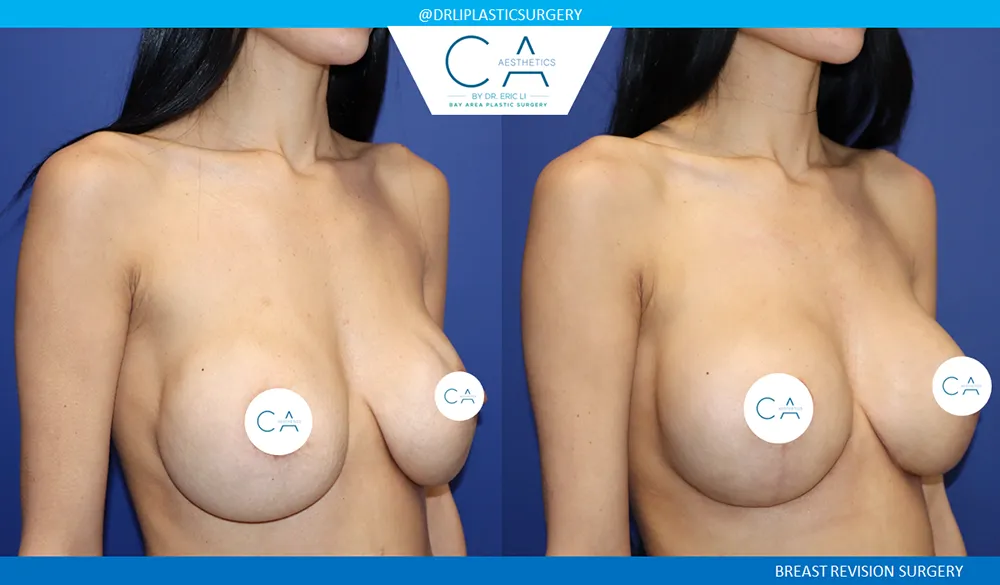 Breast Revision case #9509