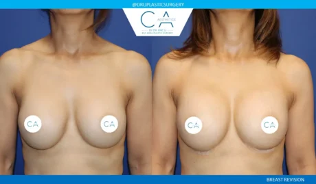 Breast Revision case #9504
