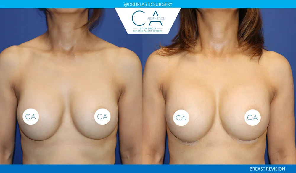 Breast Revision case #9504