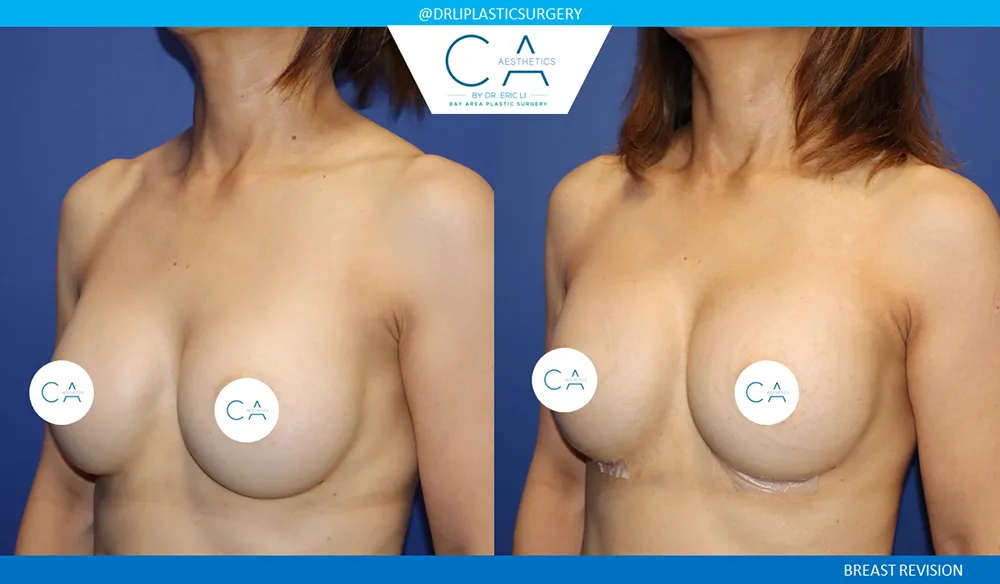 Breast Revision case #9504