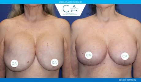 Breast Revision case #9498