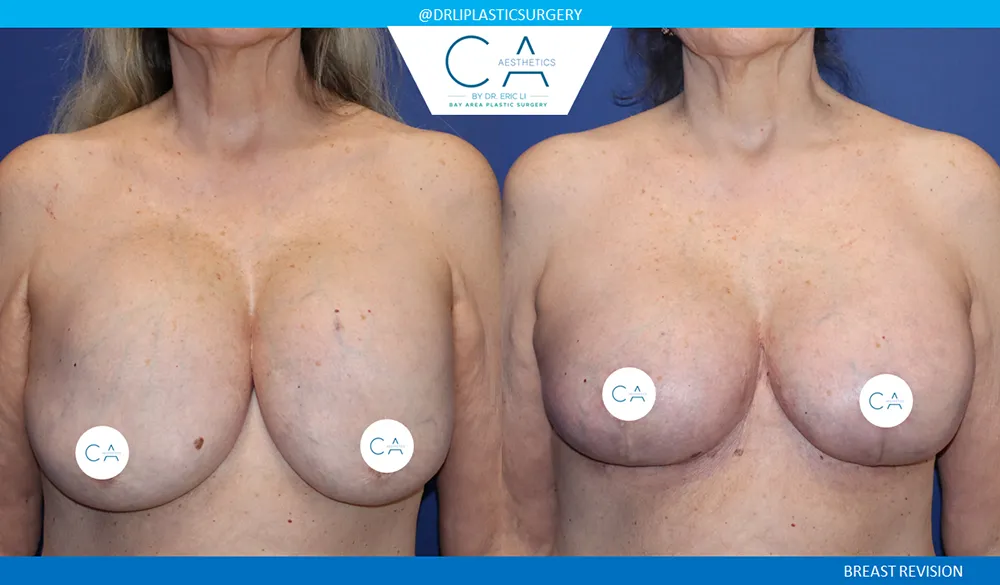 Breast Revision case #9498