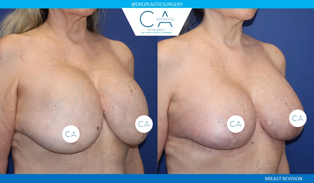 Breast Revision case #9498