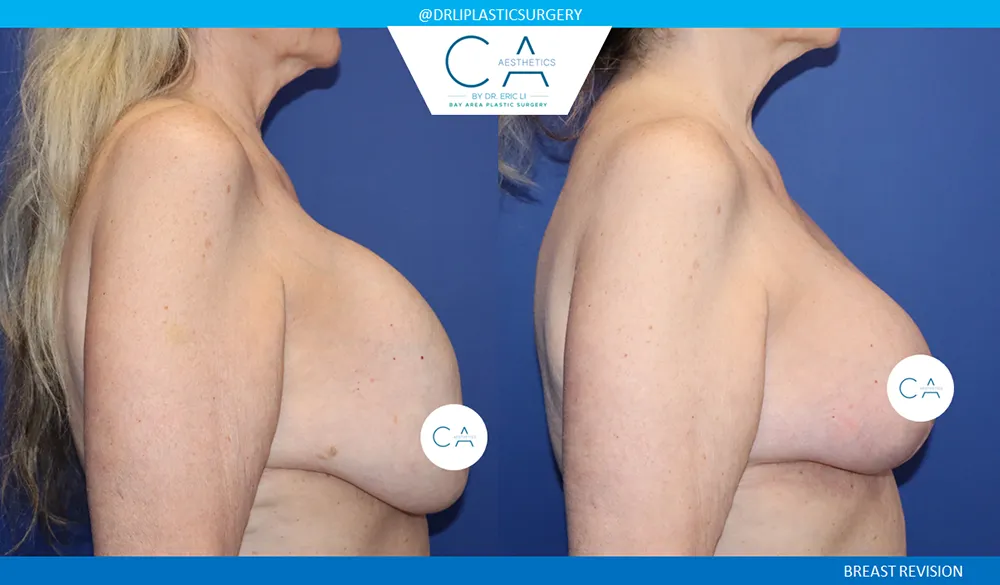 Breast Revision case #9498