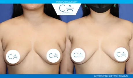 Breast Revision case #9493