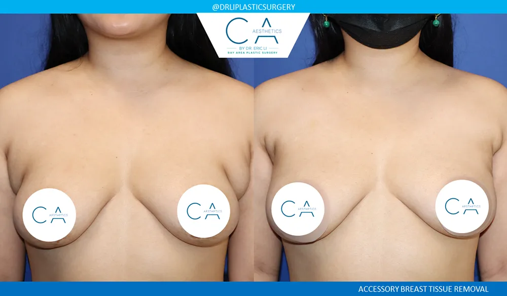 Breast Revision case #9493