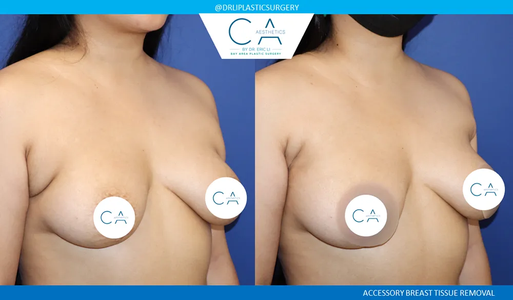 Breast Revision case #9493