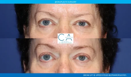 Brow Lift case #9482