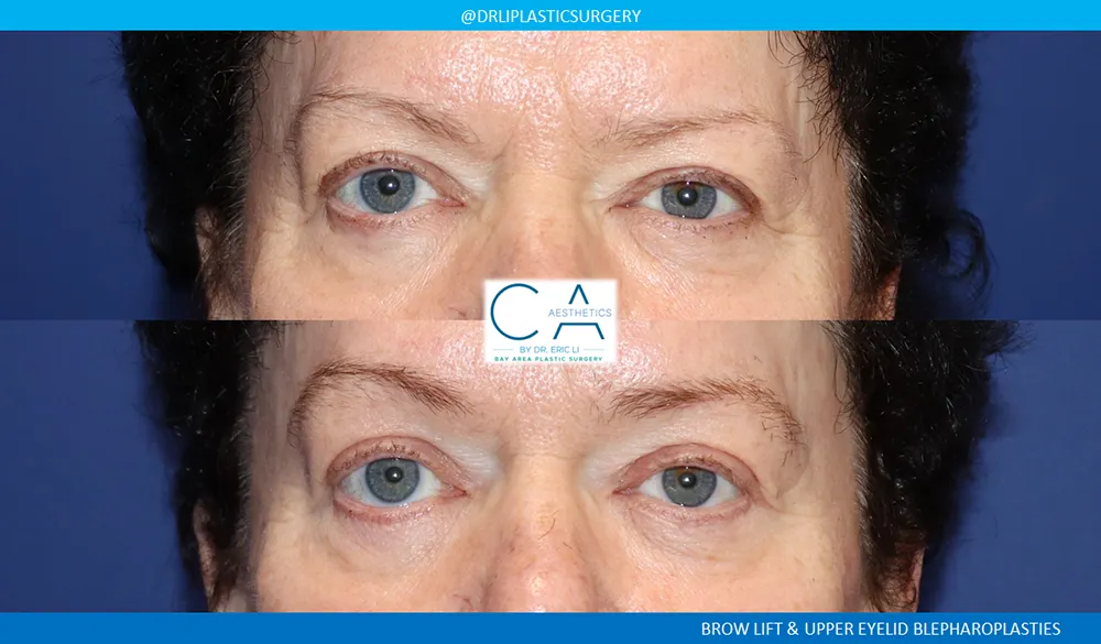Brow Lift case #9482