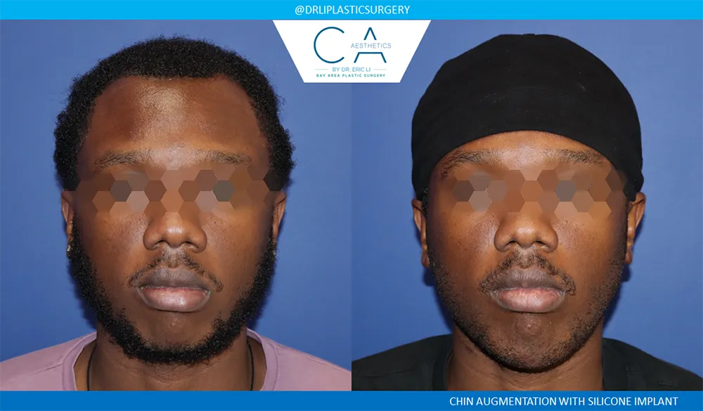 Facial Implants and Fat Transfer case #9487