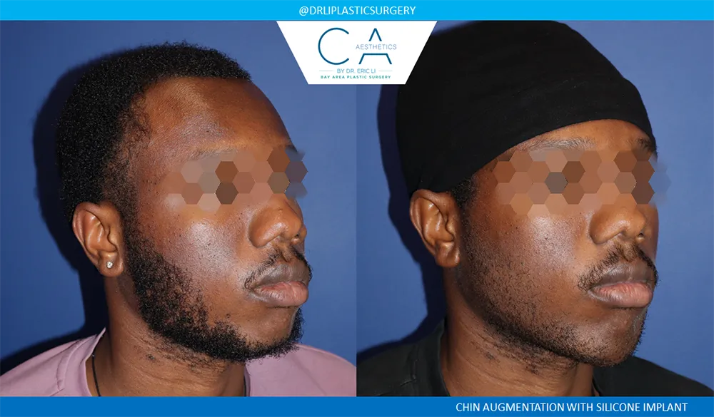 Facial Implants and Fat Transfer case #9487