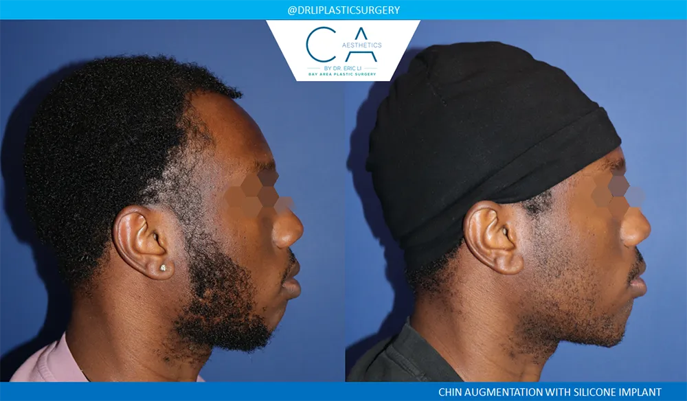 Facial Implants and Fat Transfer case #9487