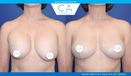 Breast Implant Removal case #9632