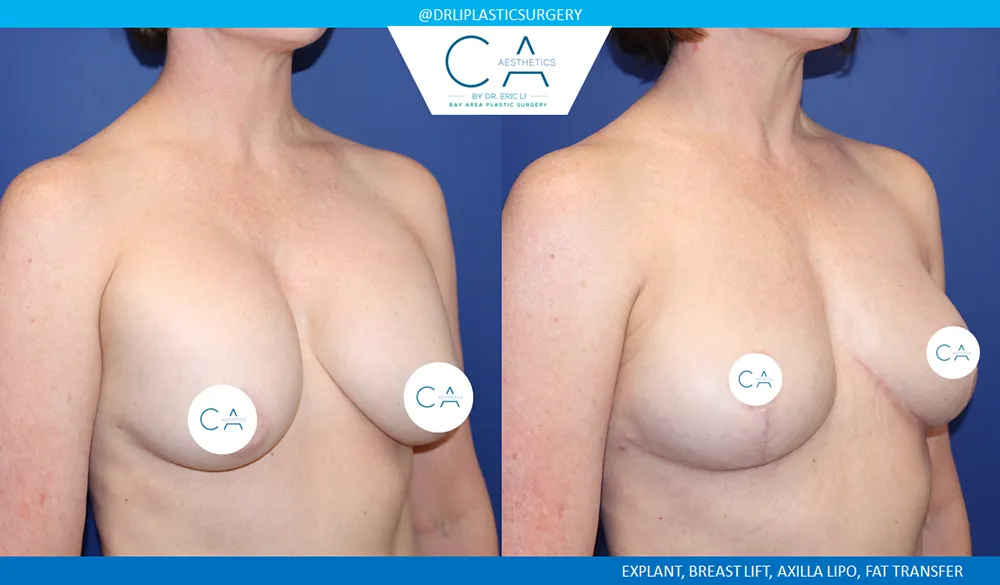 Breast Implant Removal case #9632