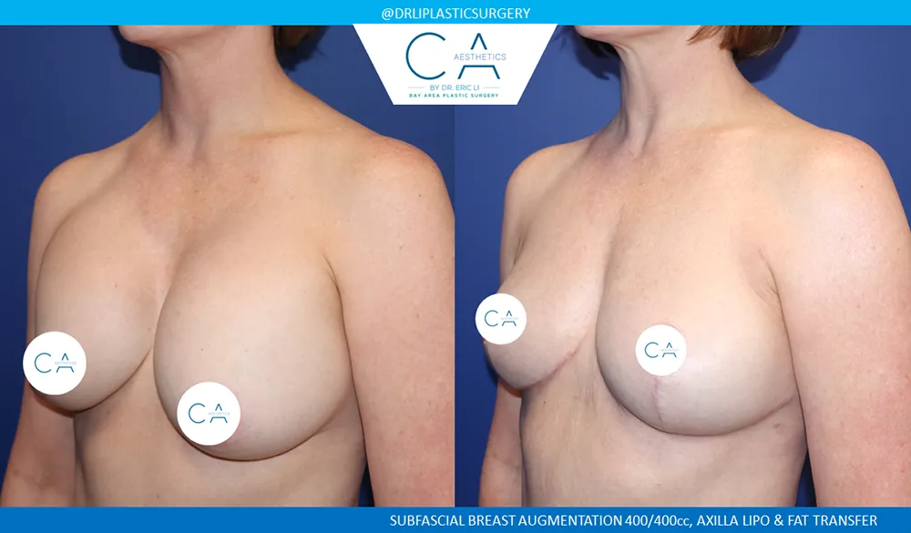 Breast Implant Removal case #9632