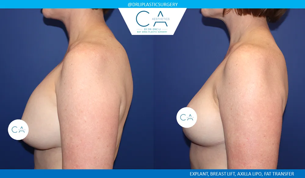 Breast Implant Removal case #9632