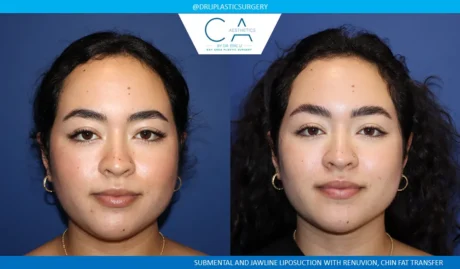 Face & Neck Liposuction case #9375