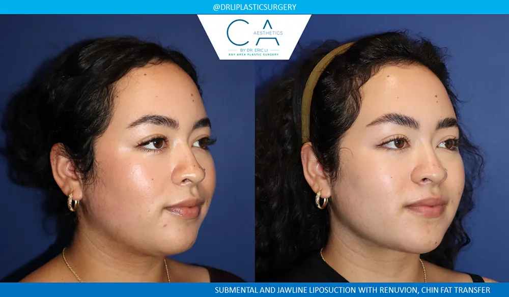 Face & Neck Liposuction case #9375