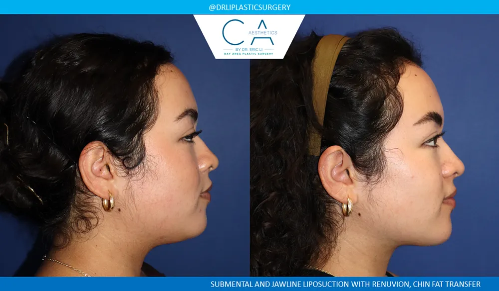Face & Neck Liposuction case #9375