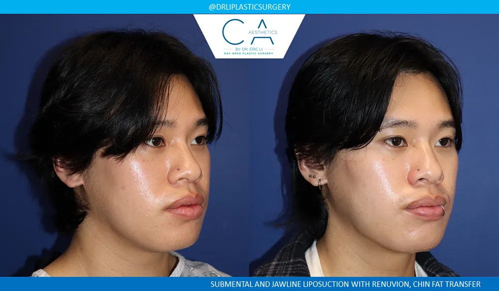 Face & Neck Liposuction case #9370