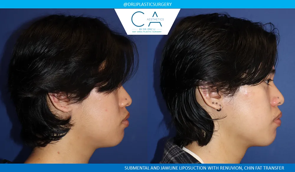 Face & Neck Liposuction case #9370