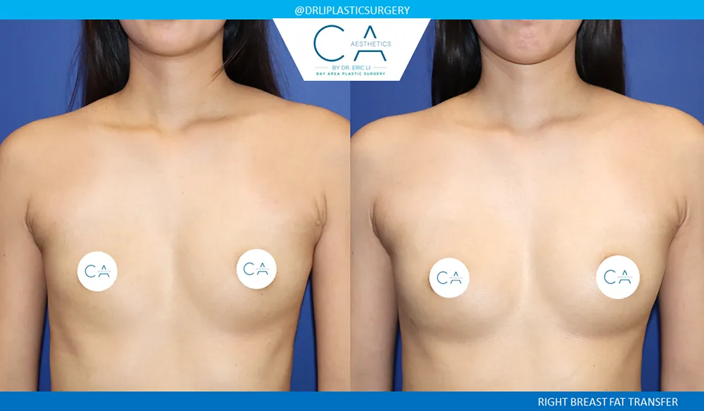 Fat Transfer Breast Augmentation case #9466