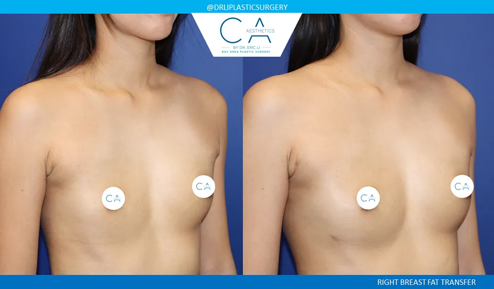 Fat Transfer Breast Augmentation case #9466