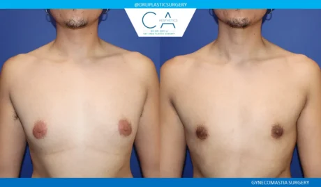 Gynecomastia case #9458