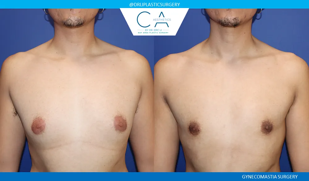 Gynecomastia case #9458