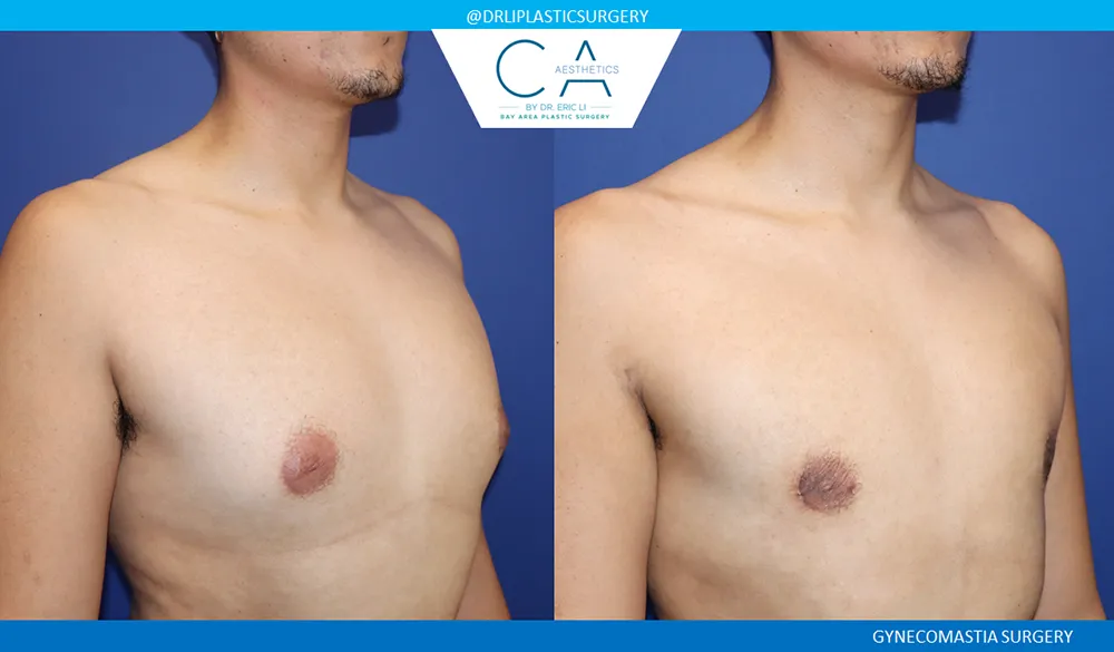 Gynecomastia case #9458