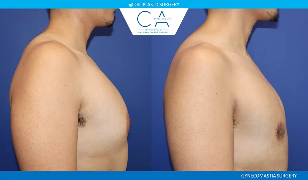 Gynecomastia case #9458