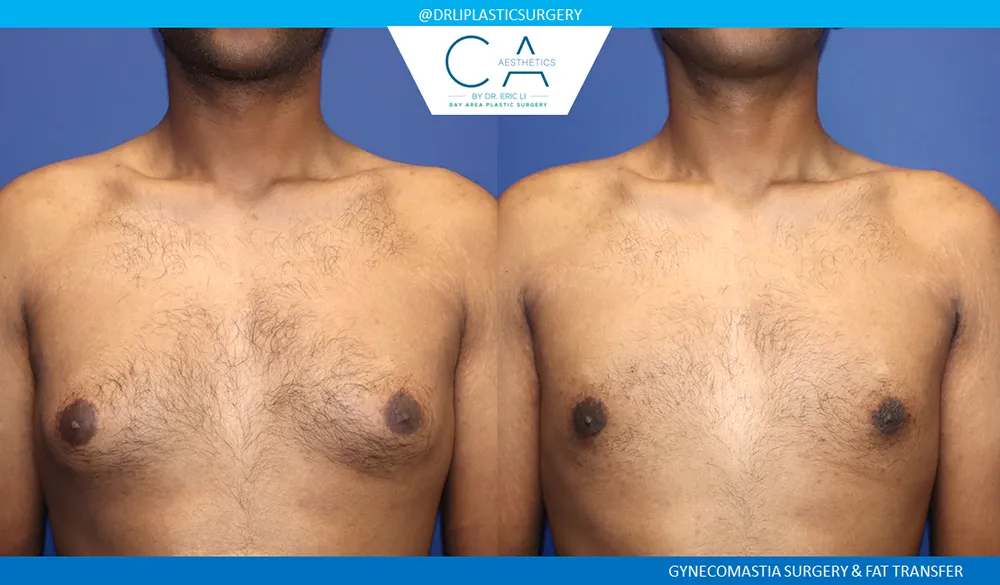 Gynecomastia case #9452
