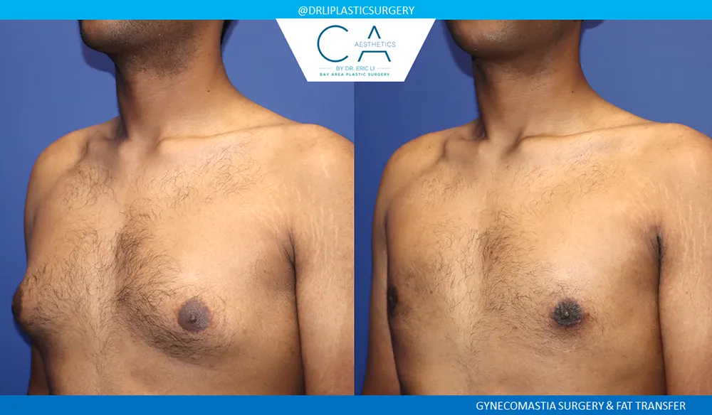 Gynecomastia case #9452