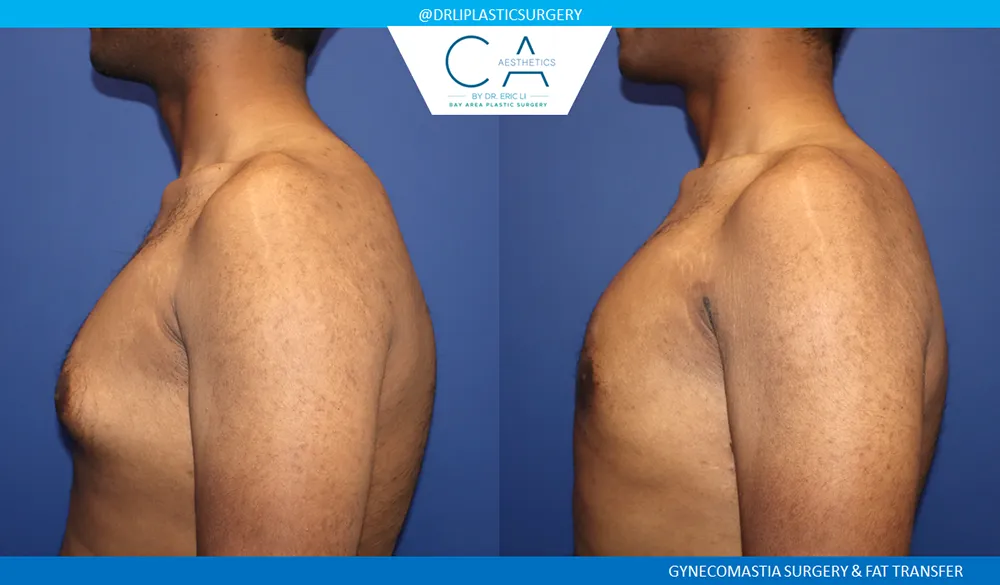 Gynecomastia case #9452