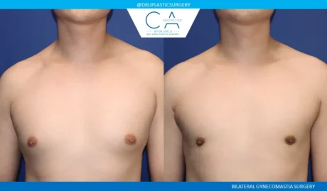 Gynecomastia case #9444