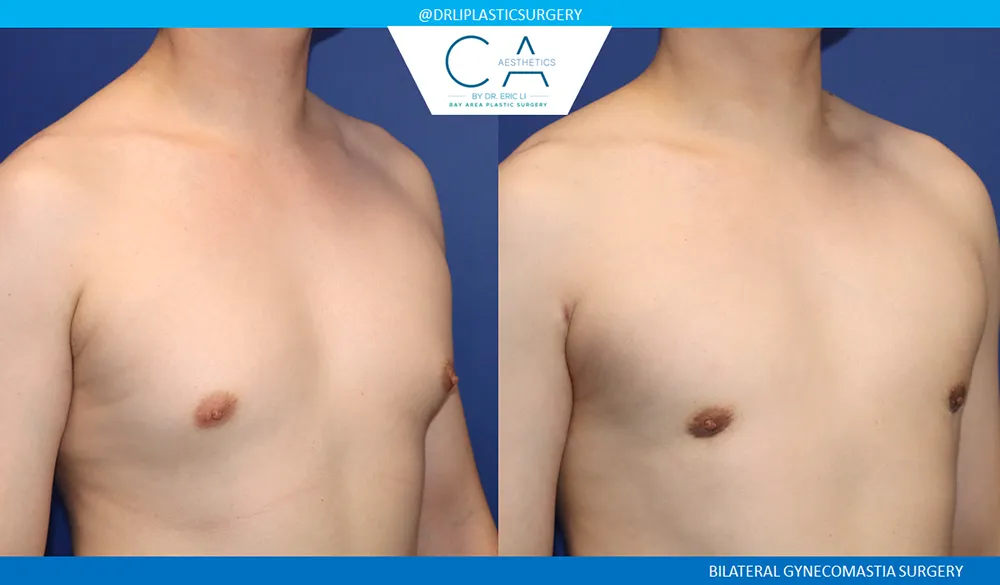 Gynecomastia case #9444