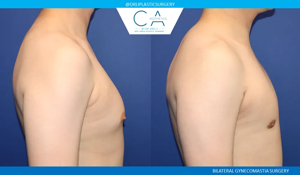 Gynecomastia case #9444