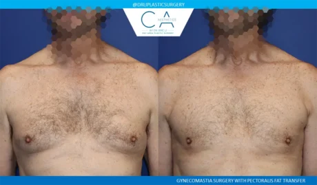 Gynecomastia case #9438