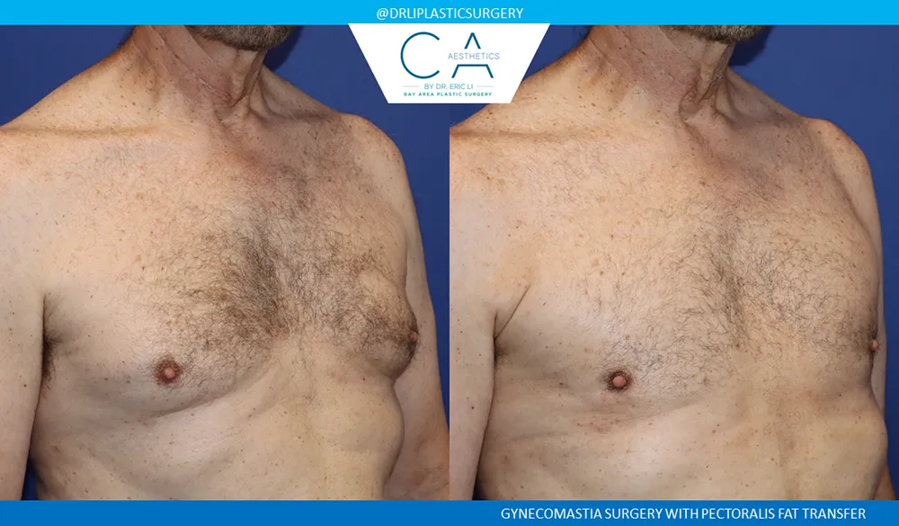 Gynecomastia case #9438