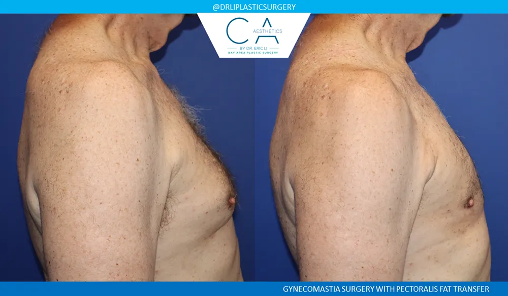 Gynecomastia case #9438