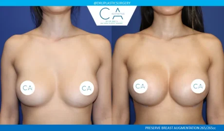 Preserve Breast Augmentation case #9392