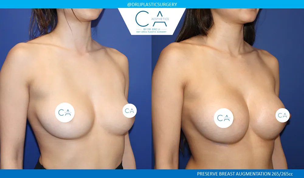 Preserve Breast Augmentation case #9392