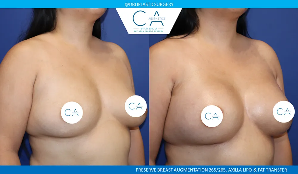 Preserve Breast Augmentation case #9386